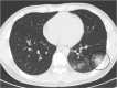 Cases illustrative of disaccord in gradings between each set of criteria. (a) An axial chest CT image of a 24-year-old male without COVID-19 shows segmental GGOs and consolidation with bronchial wall thickening (dotted circle). The consensus grading was CO-RADS 2, COVID-RADS 3, indeterminate appearance in the RSNA expert consensus statement, indeterminate in the BSTI guidance statement. As illustrated in this case, if observers consider the findings compatible with typical bronchopneumonia, CO-RADS enables classification as a lower grade than do the other three sets of criteria. (b) An axial chest CT image of a 35-year-old female with COVID-19 shows multifocal peribronchovascular segmental centrilobular GGOs with bronchial wall thickening (dotted circle). There were centrilobular GGOs on other images (not shown). The consensus grading was CO-RADS 2, COVID-RADS 2B, atypical appearance in the RSNA expert consensus statement, and indeterminate in the BSTI guidance statement. As illustrated in this case, lesions with centrilobular distribution may be underestimated in CO-RADS and the RSNA expert consensus statement. (c) An axial chest CT image of a 28-year-old male with COVID-19 shows peripheral, multifocal rounded GGOs with visible intralobular lines in the left lower lobe (dotted circle). The consensus grading was CO-RADS 4, COVID-RADS 3, typical appearance in the RSNA expert consensus statement, and classic COVID-19 in the BSTI guidance statement. As illustrated in this case, CO-RADS classifies lesions with unilateral distribution as grade 4 despite their typical appearance seen in COVID-19, while the other three sets of criteria assigning it to the respective highest grade.
