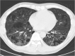 Cases illustrative of diagnostic challenges with severe pre-existing pulmonary abnormalities. (a) An axial chest CT image of a 91-year-old male without COVID-19 shows peripheral multifocal GGOs (dotted circles) in the background of usual interstitial pneumonia and moderate emphysema. There was a definite honeycomb lung destruction on other images (not shown). The consensus grading was CO-RADS 4, COVID-RADS 2B, typical appearance in the RSNA expert consensus statement, and indeterminate in the BSTI guidance statement. (b) An axial chest CT image of a 57-year-old male with COVID-19 shows severe emphysema and airspace expansion with fibrosis. The consensus grading was CO-RADS 1, COVID-RADS 1, negative appearance in the RSNA expert consensus statement, and indeterminate in the BSTI guidance statement.