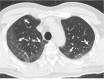 Cases illustrative of downgrading in COVID-RADS despite typical patterns seen in COVID-19. (a) An axial chest CT image of a 72-year-old male with COVID-19 shows peripheral, bilateral multifocal GGOs (arrows) with a background of mild emphysema. The consensus grading was CO-RADS 5, COVID-RADS 3+1 (downgraded to 2B), typical appearance in the RSNA expert consensus statement, and classic COVID-19 in the BSTI guidance statement. (b) An axial chest CT image of a 76-year-old female with COVID-19 shows peripheral, bilateral, multifocal GGOs with left pleural effusion (arrow). The consensus grading was CO-RADS 5, COVID-RADS 3+1 (downgraded to 2B), typical appearance in the RSNA expert consensus statement, and classic COVID-19 in the BSTI guidance statement. (c) An axial chest CT image of a 49-year-old male with COVID-19 shows peripheral, bilateral, multifocal GGOs with mild mediastinal lymph node enlargements (arrows). The consensus grading was CO-RADS 5, COVID-RADS 3+1 (downgraded to 2B), typical appearance in the RSNA expert consensus statement, and classic COVID-19 in the BSTI guidance statement.
