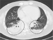 Cases illustrative of upgrading encountered in COVID-RADS. (a) An axial chest CT image of a 79-year-old female without COVID-19 shows consolidation, and centrilobular nodules without GGOs in the right lower lobe, representing typical appearances in bronchial pneumonia (dotted circle). There was bronchial wall thickening on other images (not shown). The consensus grading was CO-RADS 2, COVID-RADS 2A+1 (=2B), atypical appearance in the RSNA expert consensus statement, and non-COVID in the BSTI guidance statement. (b) An axial chest CT image of a 52-year-old male without COVID-19 shows segmental consolidation, reflecting typical appearance in lobar pneumonia (dotted circles). There was bilateral pleural effusion in this case (not shown in this figure), and the consensus grading was CO-RADS 2, COVID-RADS 2A+1 (=2B), atypical appearance in the RSNA expert consensus statement, and non-COVID in the BSTI guidance statement. (c) An axial chest CT image of a 23-year-old male without COVID-19 shows diffuse moderate bronchial wall thickening (arrows). The consensus grading was CO-RADS 1, COVID-RADS 2A, negative in the RSNA expert consensus statement, and non-COVID in the BSTI guidance statement. (d) An axial chest CT image of a 79-year-old male without COVID-19 shows bronchial wall thickening (arrow) but is otherwise normal. Bilateral gravity-dependent ground-glass opacities were considered non-pathological changes. The consensus grading was CO-RADS 2, COVID-RADS 2A, atypical appearance in the RSNA expert consensus statement, and non-COVID in the BSTI guidance statement. As illustrated in this case, COVID-RADS classifies bronchial thickening into higher grades than the other three sets of criteria.