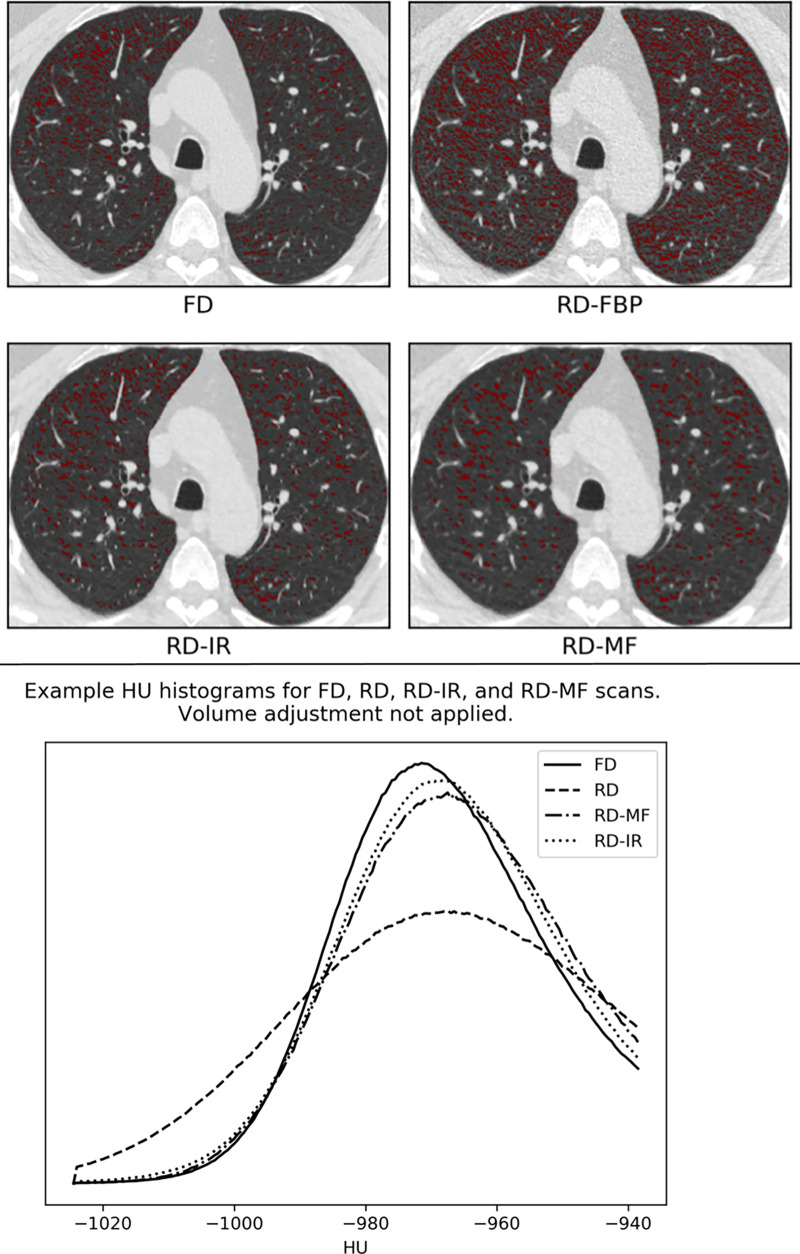 Effects of varying dose and noise reduction filtering. In this example, the difference in lung volumes between reduced-dose (RD) and standard fixed-dose (FD) scans were negligible and volume adjustment was not applied. (Top) Low-attenuating area less than −950 (LAA−950) differences between the FD, RD, RD-iterative reconstruction (RD-IR), and RD-median filter (RD-MF) scans presented in this study. (Bottom) Lung attenuation histograms for FD, RD, RD-MF, and RD-IR. FBP = filtered back projection.