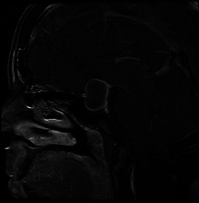 Case of an atypical pituitary abscess pmc