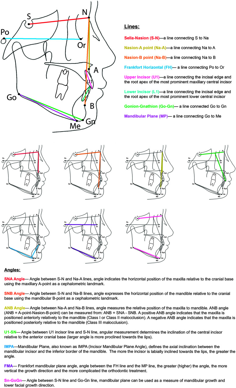 The first image shows the outline of a human face. The curves inside the outline represent the lateral cephalogram tracing points. Various points and lines are marked inside the outline. Point N is marked behind the top of the nose. Point O r is marked behind the middle nose. Point A is marked behind the upper lip. Points U 1 and L 1 are marked on the front teeth of the upper and lower jaw, respectively. Point B is marked behind the lower lip. Points G n and M e are marked on the lower jaw. Point G o is marked at the rearmost point of the lower jaw. Points P o and S are marked near the ear. A red line is marked between points S and N. A blue line is marked between points P o and O r. An orange is line marked between points N and B. A yellow line is marked between points N and A. A pink line is marked along U 1. A blue line is marked along L 1. A green line is marked between points G o and G n. A dark pink line is marked between points G o and M e. The interpretation of the lines is as follows. Red line: Sella Nasion, S to N. A line connecting S to N a. Yellow line: Nasion A point, N a to A. A line connecting N a to A. Orange line: Nasion B point, N a hyphen B. A line connecting N a to B. Blue line: Frankfort Horizontal, F H. A line connecting P o to O r. Pink line: Upper Incisor, U 1. A line connecting the incisal edge and the root apex of the most prominent maxillary central incisor. Blue line: Lower incisor, L 1. A line connecting the incisal edge and the root apex of the most prominent lower central incisor. Green line: Gonion Gnathion, G o hyphen G n. A line connected G o to G n. Dark pink line: Mandibular plane, M P. A line connecting G o to M e. Below the first image, 7 other face outlines are displayed and colored lines are marked inside each outline. The lines and their interpretation are as follows. 1. A red line passes through points S, N and A. S N A angle: Angle between S N and N a to A lines, angle indicates the horizontal position of the maxilla relative to the cranial base using the maxillary A point as a cephalometric landmark. 2. An orange line passes through S, N, and B. S N B angle: Angle between S N and N a B lines, angle expresses the horizontal position of the mandible relative to the cranial base using the mandibular B point as a cephalometric landmark. 3. A yellow line is marked between A, N, and B. Yellow A N B angle: Angle between N a to A and N a to B lines. A N B angle measures the relative position of the maxilla to mandible. A N B angle can be measured from A N B equals S N A minus S N B. A positive A N B angle indicates that the maxilla is positioned anteriorly relatively to the mandible, Class 1 or Class 2 malocclusion cases. A negative A N B angle indicates that the maxilla is positioned posteriorly relative to the mandible, Class 3 malocclusion cases. 4. Green lines are marked between S, N and U 1. Green U 1 to S N: Angle between U 1 incisor line and S N line, angular measurement determines the inclination of the central incisor relative to the anterior cranial base, larger angle is more proclined towards the lips. 5. A blue line is marked between G o, M e and L 1. Blue I M P A: Mandibular plane; Also known as I M P A, incisor mandibular plane angle, defines the axial inclination between the mandibular incisor and the inferior border of the mandible. The more the incisor is labially inclined towards the lips, the greater the angle. 6. Violet lines are drawn between P o and O r and between G o and M e. Violet F M A, Frankfort mandibular plane angle, Angle between the F H line and the M P line, the greater or higher the angle, the more vertical the growth direction and the more complicated the orthodontic treatment. 7. A pink line is marked between S and N. Another pink line is marked between G o and G n. Pink S n G o G n: Angle between S N line and G o G n line, mandibular plane can be used as a measure of mandibular growth and lower facial growth direction.
