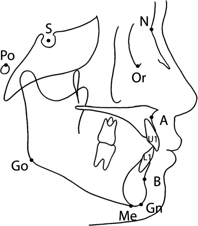 The figure shows the outline of a human face. The curves inside the outline represent the lateral cephalogram tracing points. Point N is marked behind the top of the nose. Point O r is marked behind the middle nose. Point A is marked behind the upper lip. Points U 1 and L 1 are marked on the front teeth of the upper and lower jaw, respectively. Point B is marked behind the lower lip. Points G n and M e are marked on the lower jaw. Point G o is marked at the rearmost point of the lower jaw. Points P o and S are marked near the ear.