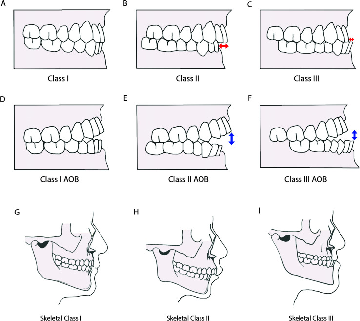 6 diagrams depict dental malocclusions and 3 diagrams depict skeletal malocclusions. A. Class 1 dental occlusion. The teeth in the upper jaw are aligned in a typical relationship with the teeth in the lower jaw, with upper molars slightly behind the lower molars and upper incisors slightly in front of lower incisors. B. Class 2 dental malocclusion. The teeth in the upper jaw are farther forward relative to the corresponding teeth in the lower jaw. C. Class 3 dental malocclusion. The teeth in the lower jaw are anterior to the corresponding teeth in the upper jaw. D. Class 1 A O B dental malocclusion. The teeth in the upper jaw do not reach down as far as the anterior teeth in the lower jaw. Class 2 A O B dental malocclusion. The teeth in the upper jaw are farther forward relative to the teeth in the lower jaw and also do not reach down as far as the anterior teeth in the lower jaw. F. Class 3 A O B dental malocclusion. The teeth in the lower jaw are anterior to the corresponding teeth in the upper jaw. The teeth in the upper jaw also do not reach down as far as the anterior teeth in the lower jaw. G. Skeletal class 1 skeletal occlusion. The mandible and the maxilla have typical proportions and the teeth line up with upper molars slightly behind the lower molars and upper incisors slightly in front of lower incisors. H. Skeletal class 2 skeletal malocclusion. The mandible is small in relation to the maxilla, resulting in upper teeth that are farther forward than in class 1. I. Skeletal class 3 skeletal malocclusion. The mandible is large in relation to the maxilla, resulting in lower teeth that are anterior to the corresponding teeth in the upper jaw.