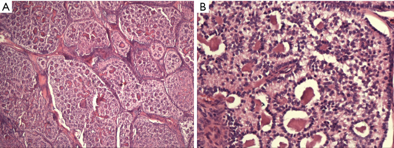 A Recurrence Of Advanced Malignant Sex Cord Tumor With Annular Tubules