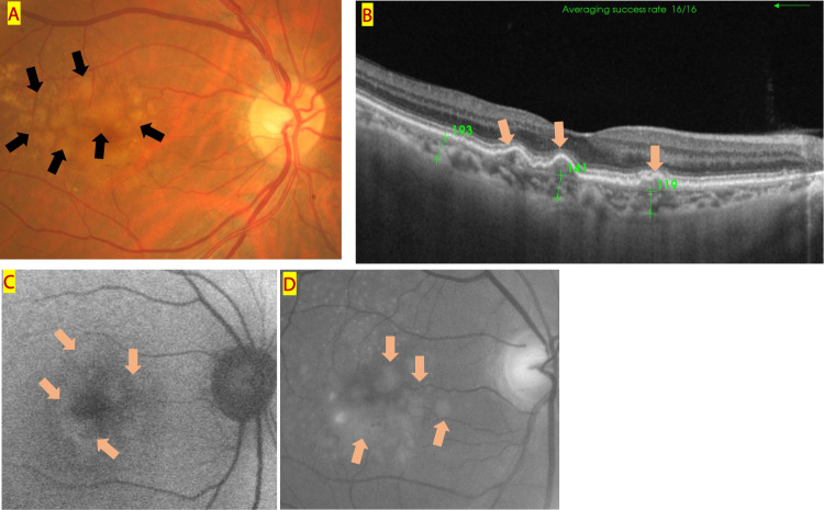 Drusen and pachydrusen: the definition, pathogenesis, and clinical ...