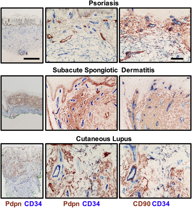 Altered Dermal Fibroblasts In Systemic Sclerosis Display Podoplanin And 