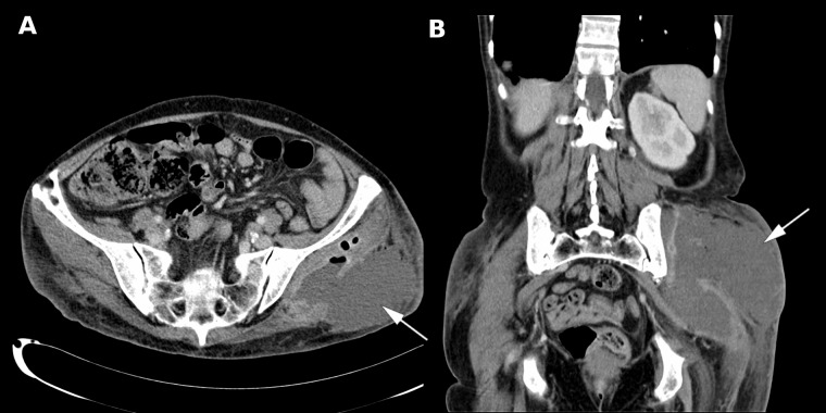 Gas-forming gluteal abscess after intramuscular self-injections due to ...