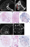 Illustrative examples of sampled lung areas with ex vivo CT, micro-CT,
and histologic staining. (A) Axial noncontrast ex vivo CT scan shows highly
abnormal (25% healthy, 55% reticulation, 20% ground-glass opacification)
lung findings. (B–E) Micro-CT scan (B) and histopathologic images
(hematoxylin-eosin [C, D] and trichrome [E] staining; magnification,
×5 for C and E, ×20 for D) of the area highlighted with the
circle in A show paraseptal and interstitial fibrotic changes. (F) Axial
noncontrast ex vivo CT scan shows lung considered healthy (80%), with mild
ground-glass opacification (15%) and limited reticulation (5%). (G–J)
Micro-CT scan (G) and histopathologic images (hematoxylin-eosin [H, I] and
trichrome [J] staining; magnification, ×5 for H and J, ×20 for
I) of the matched location (circle in F) show paraseptal and interstitial
fibrosis. Awy = airway, BV = blood vessel.