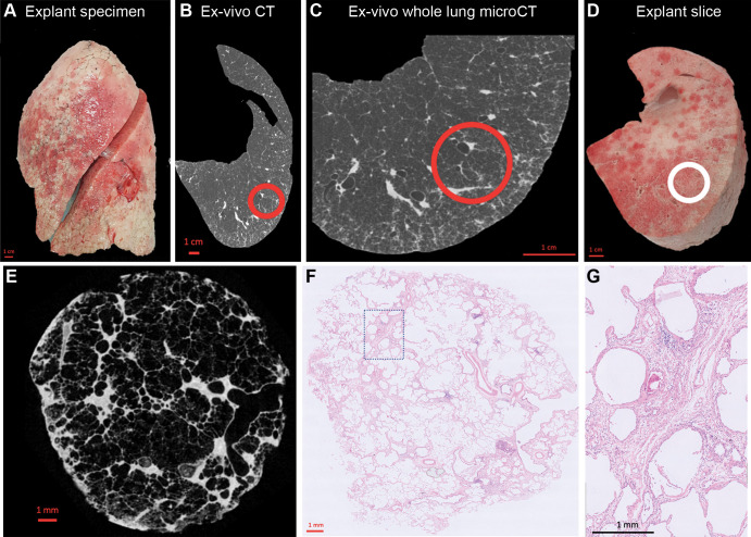 Study design. (A) Photograph shows the explanted lung frozen solid in liquid nitrogen fumes. (B) Axial noncontrast ex vivo CT scan of the specimen is obtained while it is frozen. (C) Whole-lung micro-CT scan is obtained for better spatial resolution. (D) Photograph shows the lung sliced transversally in 2-cm slices. (E) Micro-CT scan of a core sample (indicated with the circle in B–D) is obtained. (F) Matched histologic image (hematoxylin-eosin stain; magnification, ×5) is shown at the same location as the micro-CT scan. (G) High-magnification histologic image (hematoxylin-eosin stain; magnification, ×20) shows paraseptal fibrosis.