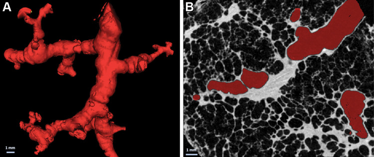 (A) Three-dimensional reconstruction of distal airway tree based on specimen micro-CT scans shows typical tortuous and distorted airways. (B) Cross-sectional micro-CT panel shows the absence of overt fibrosis in the vicinity of the airway, which is highlighted in red.