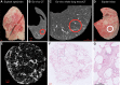 Study design. (A) Photograph shows the explanted lung frozen solid in
liquid nitrogen fumes. (B) Axial noncontrast ex vivo CT scan of the specimen
is obtained while it is frozen. (C) Whole-lung micro-CT scan is obtained for
better spatial resolution. (D) Photograph shows the lung sliced
transversally in 2-cm slices. (E) Micro-CT scan of a core sample (indicated
with the circle in B–D) is obtained. (F) Matched histologic image
(hematoxylin-eosin stain; magnification, ×5) is shown at the same
location as the micro-CT scan. (G) High-magnification histologic image
(hematoxylin-eosin stain; magnification, ×20) shows paraseptal
fibrosis.