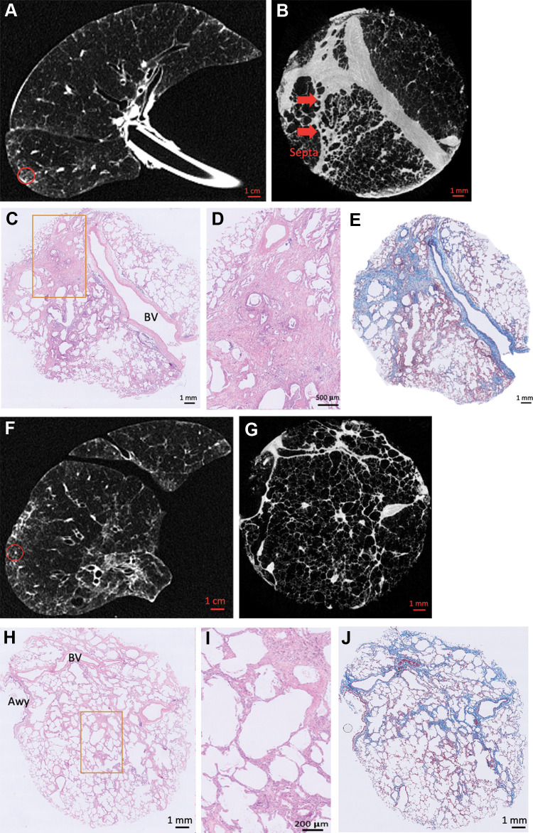 Illustrative examples of sampled lung areas with ex vivo CT, micro-CT, and histologic staining. (A) Axial noncontrast ex vivo CT scan shows highly abnormal (25% healthy, 55% reticulation, 20% ground-glass opacification) lung findings. (B–E) Micro-CT scan (B) and histopathologic images (hematoxylin-eosin [C, D] and trichrome [E] staining; magnification, ×5 for C and E, ×20 for D) of the area highlighted with the circle in A show paraseptal and interstitial fibrotic changes. (F) Axial noncontrast ex vivo CT scan shows lung considered healthy (80%), with mild ground-glass opacification (15%) and limited reticulation (5%). (G–J) Micro-CT scan (G) and histopathologic images (hematoxylin-eosin [H, I] and trichrome [J] staining; magnification, ×5 for H and J, ×20 for I) of the matched location (circle in F) show paraseptal and interstitial fibrosis. Awy = airway, BV = blood vessel.