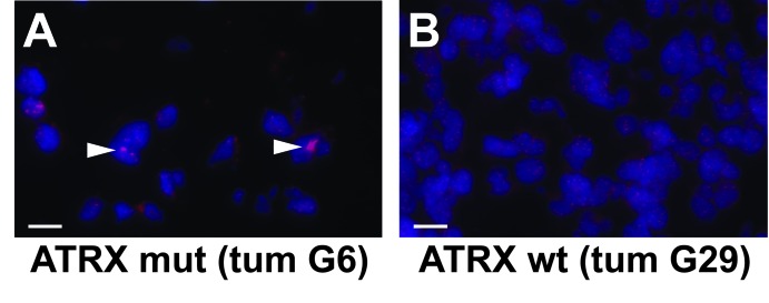 Whole exome sequencing identifies ATRX mutation as a key molecular ...