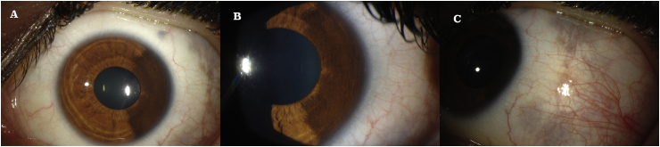 Melanosis oculi - PMC