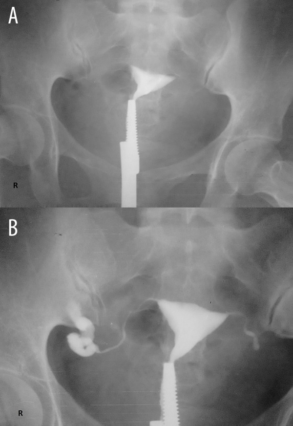 Contrast Intravasation During Hysterosalpingography PMC contrast-intravasation-during-hysterosalpingography-pmc