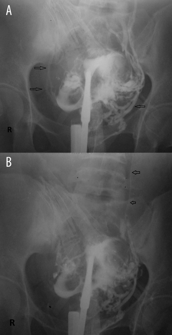 Contrast Intravasation During Hysterosalpingography PMC ear-nose-throat