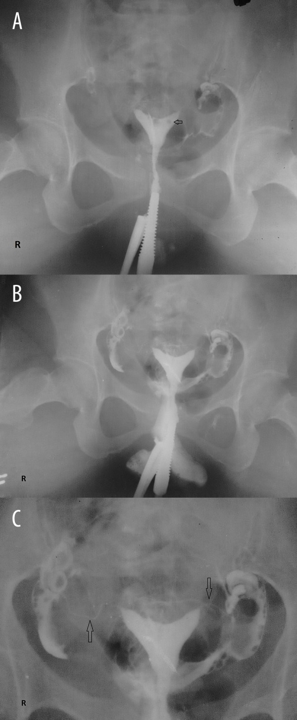 Contrast Intravasation During Hysterosalpingography PMC contrast-intravasation-during-hysterosalpingography-pmc