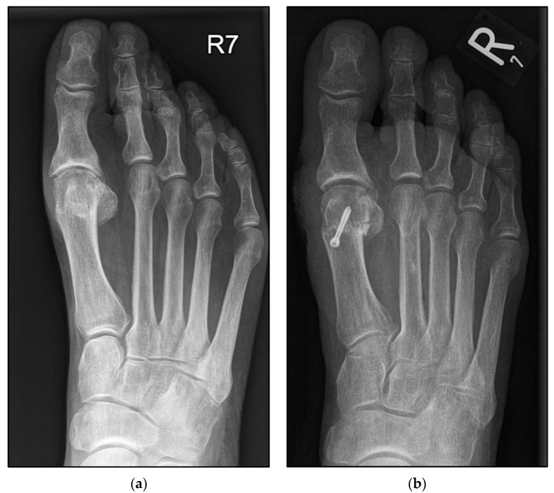 The Conventional Weil Osteotomy Does Not Require Screw Fixation - PMC