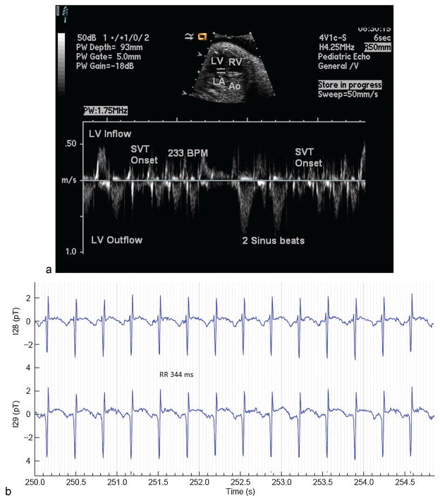 Diagnosis and Treatment of Fetal Arrhythmia - PMC