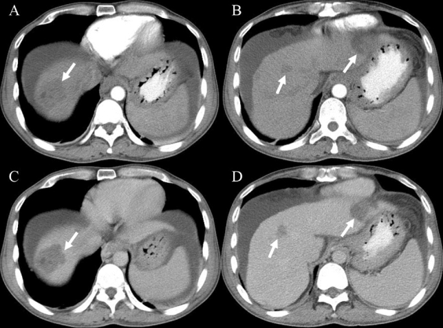 Hepatic sclerosed hemangioma and sclerosing cavernous hemangioma: a ...