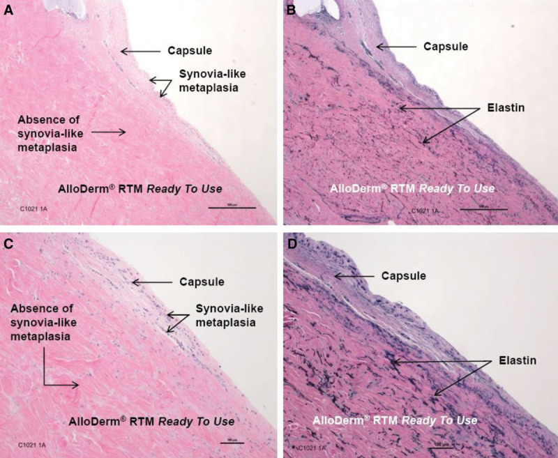 AlloDerm RTU Integration and Clinical Outcomes When Used for ...