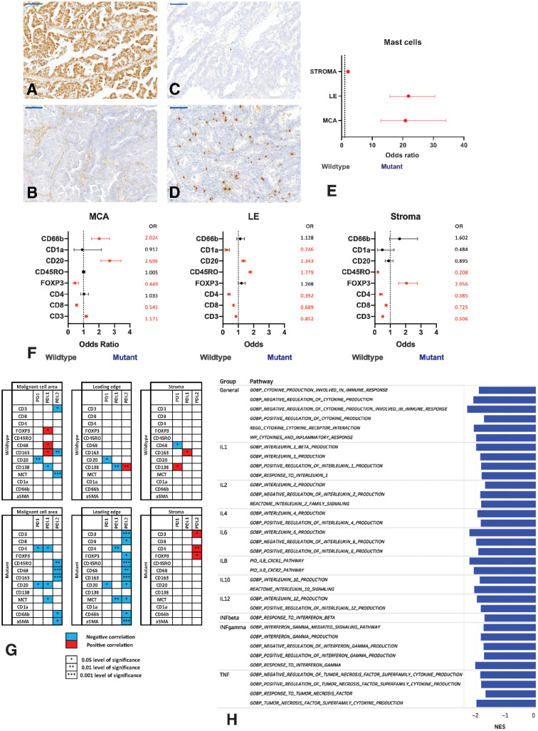 Figure 4. The immune microenvironment of ARID1A-wildtype (ARID1Awt) and -mutant (ARID1Amut) CCOC. A and B. Representative immunohistological images of ARID1A in advanced CCOC. Anti-ARID1A was used to evaluate protein expression in biopsies. Representative ARID1Awt sample (A) and representative ARID1Amut sample (B). All images taken at 20× magnification; scale bar: 100 μm. C–E, Mast cells in ARID1Awt and ARID1Amut CCOC were assessed. Mast cells were identified using anti-mast cell tryptase. Representative images of mast cells in anARID1Awt CCOC biopsy (C); in an ARID1Amut CCOC biopsy (D). E, Mast cells in the MCA, LE, and stroma of ARID1Amut CCOC biopsies compared with ARID1Awt tumors. Mast cells were quantified by positive cells per high powered field and significance determined using χ2. The OR is plotted; if <1, the immune population was higher in ARID1Awt tumors; >1, the population was higher in ARID1Amut tumors. All results were statistically significant. F, Comparison of ARID1Awt and ARID1Amut tumors for immune markers quantified by number of cells per high powered field. χ2 was used to determine significance. Immune markers were quantified using positive cells per high powered field via IHC across the MCA, LE, and stroma. The OR is plotted, with significant values indicated in red and nonsignificant ratios in black; if <1, the immune population was higher in ARID1Awt tumors; if >1, the population was higher in ARID1Amut tumors. G, Associations between the PD-1 axis and immune cell populations across the TME of ARID1Awt and ARID1Amut advanced CCOC was determined. Shown are associations for PD-1, PD-L1, and PD-L2 with immune cell markers across the MCA, LE, and stroma. Significance is indicated with a star, with positive associations indicated in red and negative associations in blue. H, Cytokine pathways in ARID1Awt and ARID1Amut CCOC. DEGs from the AOCS data set were ranked and pathway enrichment performed. A FDR q < 0.05 was considered significant. The normal enrichment score (NES) is plotted for pathways enriched in ARID1Amut tumors.