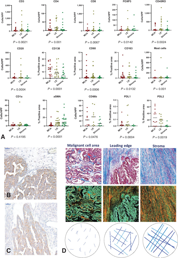 Figure 2. Variation in immune cell markers and the collagen matrix throughout the TME of advanced CCOC, with IHC identification of PDL2. A, Scatter plots showing median values for the indicated immune markers across the MCA, LE, and stroma of paired samples. Immune markers were assessed using IHC and quantified by either positive cells per high powered field (HPF) or percent positive area. The distribution of markers across the three ROI was analyzed in paired samples using a Friedman test with a post hoc Dunn multiple comparisons test; P values shown, error bars indicate medians. CD3, n = 21; CD8, n = 22; CD4, n = 16; FOXP3, n = 13; CD45RO, n = 20; CD20, n = 18; CD138, n = 18; CD68, n = 29, CD163, n = 18; mast cells, n = 18; CD1a, n = 12, αSMA, n = 34; CD66b, n = 9; PD-L1, n = 12; PD-L2, n = 12. B and C, PDL2 was evaluated using IHC on 12 samples and was confirmed using two different antibodies; scale bar: 50 μmol/L. D, Masson's trichrome was used to identify collagen (blue in the top row of images) across the MCA, LE, and stroma of 36 samples. Images were inverted to better visualize collagen content (orange in the bottom row).