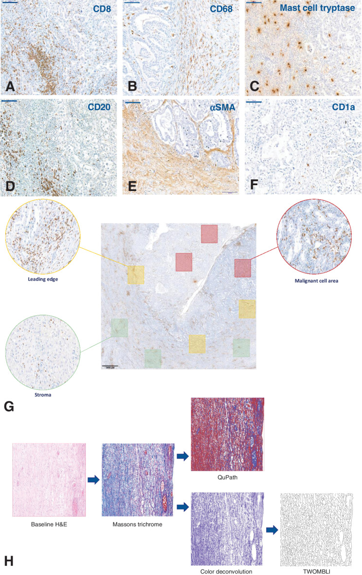 Figure 1. Examples of IHC identification of immune markers in CCOC and subsequent quantification methods. A–F, Representative IHC images used to identify immune cell populations in advanced CCOC. CD8 (A), CD68 (B), mast cell tryptase (C), CD20 (D), αSMA (E), CD1a (F). All images taken at 20× magnification; scale bar: 100 μm. G, Topographical quantification. For spatial analysis of the TME, quantification occurred within ROI. Red boxes: MCA, defined as a region that contained predominantly malignant cells; Green boxes: stromal area, defined as areas containing no malignant cells; Yellow boxes: the LE, defined as areas containing equal amounts of both malignant cells and stromal cells. Three 1×1 mm squares within each ROI were identified, with each slide having nine individually quantified areas. To remove any potential selection bias, each ROI was selected from the baseline H&E slide and translated onto consecutive slides. The immune cells shown in this example are CD8+ cells; scale bar: 1,000 μmol/L. H, Image processing pipeline for collagen analysis. Textural analysis of stained collagen was carried out using Haralick features on QuPath, and structure was analyzed using TWOMBLI. Representative images of Masson's trichrome within each ROI were either directly input into QuPath or underwent a deconvolution step on ImageJ before analysis by TWOMBLI.