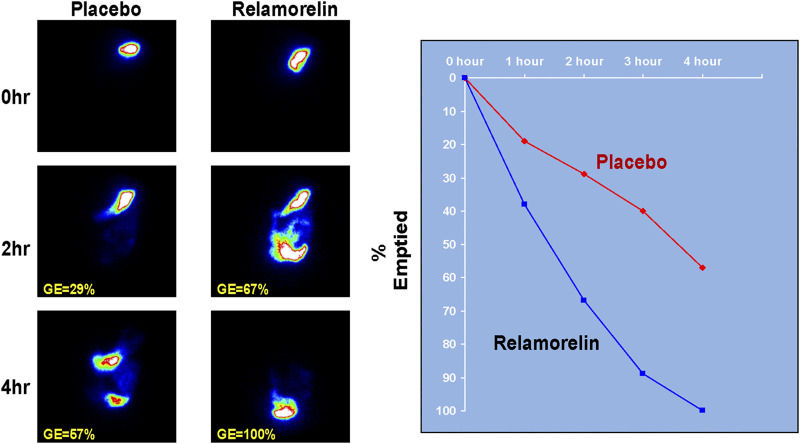 New Developments in Prokinetic Therapy for Gastric Motility Disorders - PMC