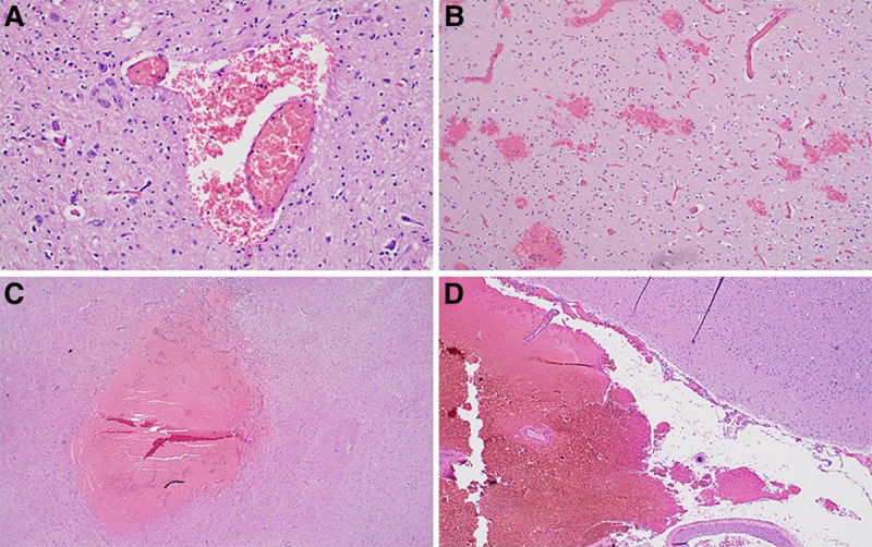 Cerebral Microbleeds and Intracranial Hemorrhages in Adult Patients on ...