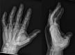 Radiographs of the left hand demonstrating diffuse subcutaneous emphysema