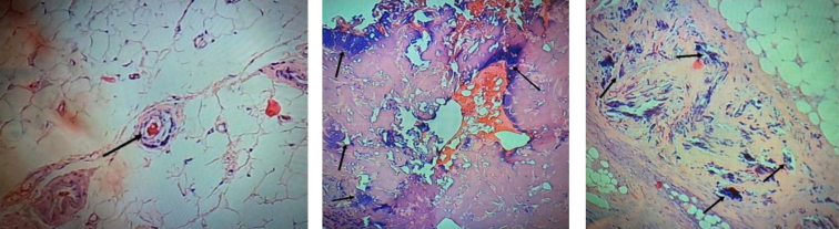 Nonuremic Calciphylaxis Associated With Hypercalcemia and Rheumatologic ...