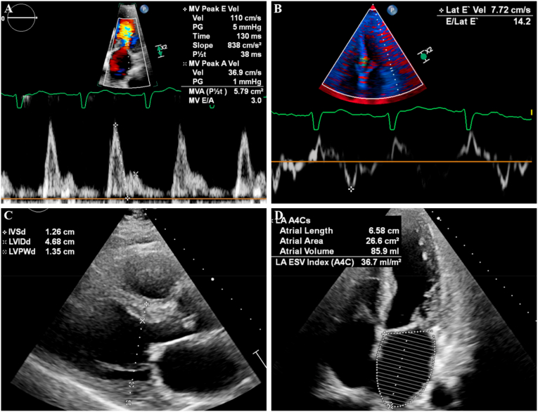 A Case Of Al Amyloidosis Presenting With Refractory Ventricular 