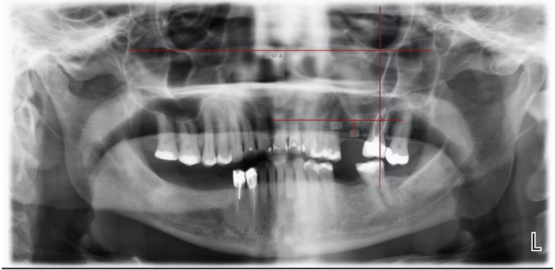 Maxillary Sinus Pneumatization Following Extractions in Riyadh, Saudi ...