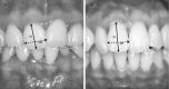 Figure 2. The determination of gingival biotypes. Crown length (CL, arrow), the distance between the gingival margin and the incisal edge of the crown and the crown width (CW, dotted arrow), and the distance between the approximal tooth surface of the borderline between the portion of the cervical and middle third of the of the maxillary right central incisor were measured, and the crown form ratio (CW/CL) was calculated to determine the pronounced scalloped and flat gingival biotypes. Flat gingival biotype (A) indicates a higher anatomical crown width/crown length ratio than pronounced scalloped gingival biotype (B).