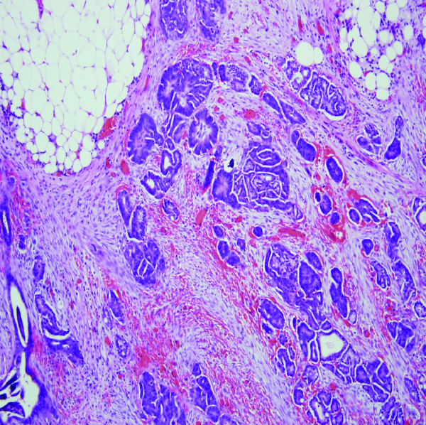 Immunohistochemical identification of primary peritoneal serous ...