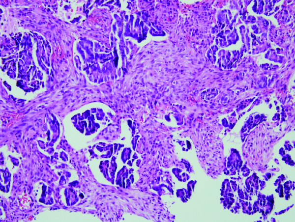 Immunohistochemical identification of primary peritoneal serous ...