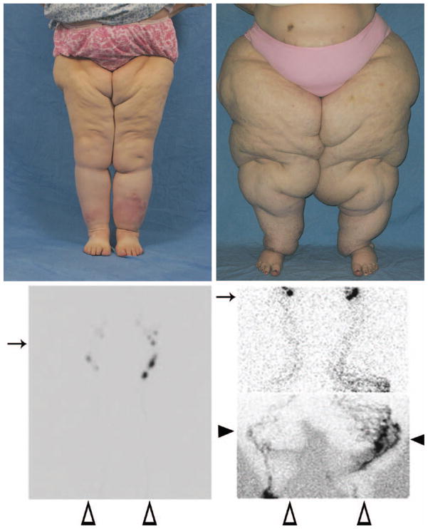 Lymphedema and Obesity: Is There a Link? - PMC