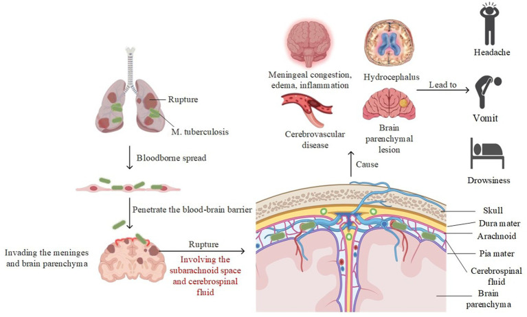 MRI advances in the imaging diagnosis of tuberculous meningitis ...