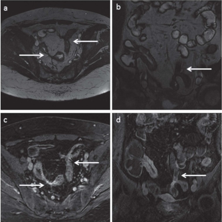 Magnetic resonance enterography (MRE) and ultrasonography (US) in the ...