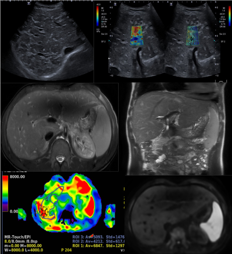 Fontan-associated liver disease: Diagnosis, surveillance, and ...