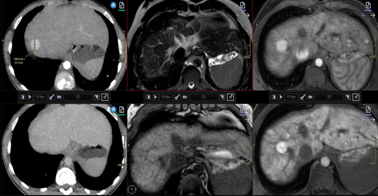 Fontan-associated liver disease: Diagnosis, surveillance, and ...