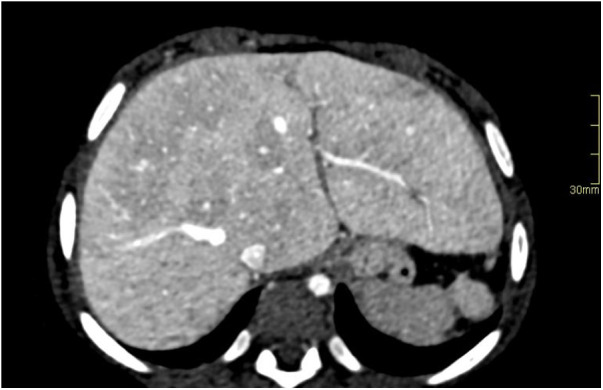 Fontan-associated liver disease: Diagnosis, surveillance, and ...