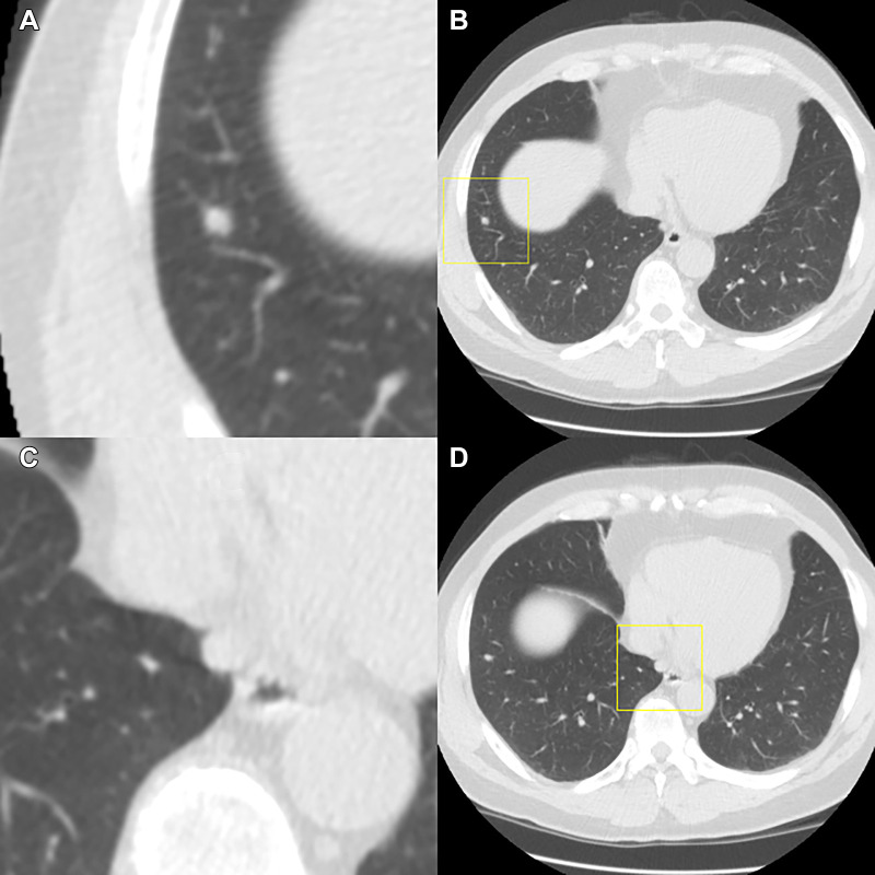 Example of a participant with a lung cancer diagnosis in the same year. The T1 scan of this participant was included in the observer study; the T0 scan showed only a 2.5-mm solid nodule in the left upper lobe. The T1 scan shows two nodules, which are depicted in this figure. Each image pair (A and B and C and D) shows one nodule displayed in a magnified view in the center (left column, field of view of 60 × 60 mm) and in a normal view (right column) on the T1 scan. All observers categorized the scan as Lung Imaging Reporting and Data System (Lung-RADS) 3 when using the dedicated CT lung screening viewer, whereas three observers categorized the scan as Lung-RADS 4A when using the standard viewer. (A, B) The top images show a new, small solid nodule in the right lower lobe, which was detected by the computer-aided detection (CAD) program and was measured as 5.2 mm in diameter by the segmentation software. As a result, all observers gave this nodule a Lung-RADS 3 categorization when using the dedicated CT lung screening viewer. (C, D) The bottom images show a new subpleural nodule close to the heart that was not detected by the CAD program. This nodule was only detected by two of seven readers when using the standard viewer and was detected by none of the readers in the dedicated CT lung screening viewer. One reader measured the nodule in the right lower lobe as having a diameter of 6 mm when using the standard viewer, also leading to a 4A categorization of the scan, while still missing the nodule close to the heart.