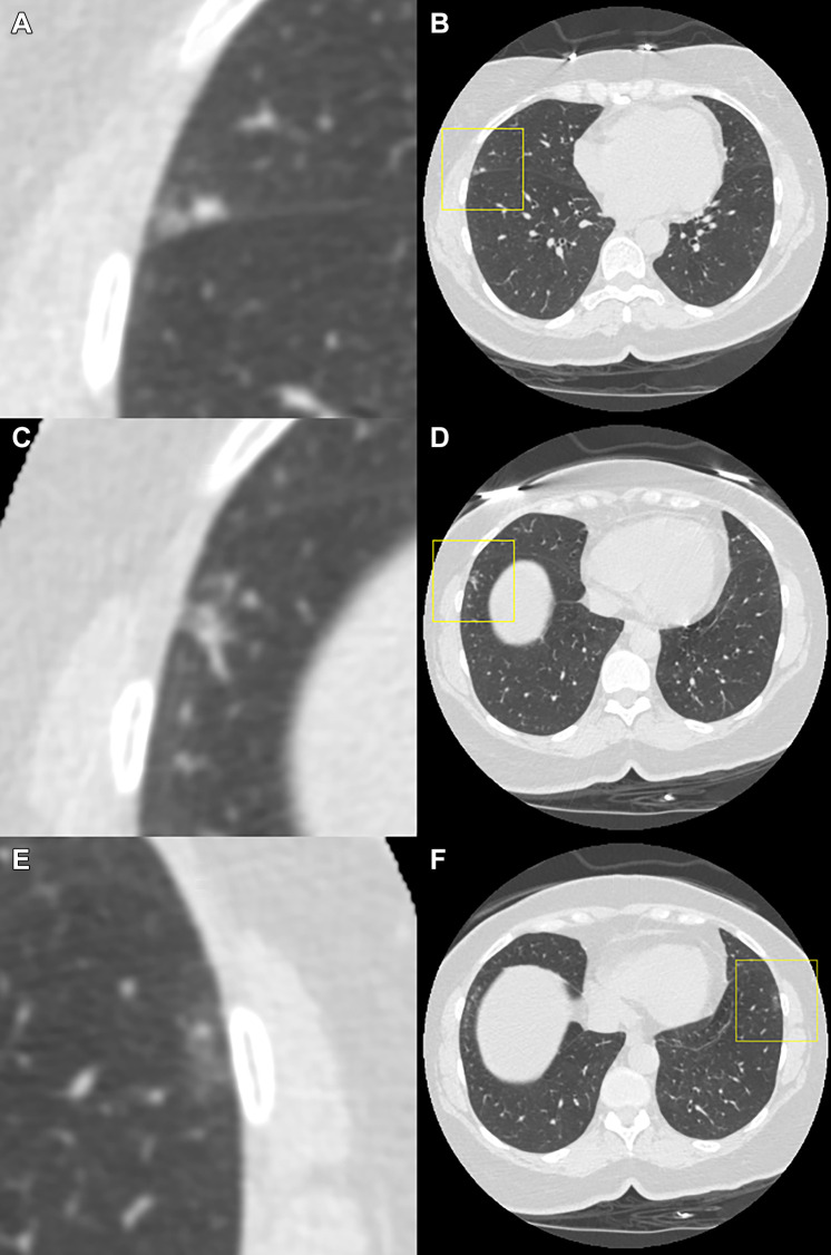 Example of a case in which the observers disagree on the Lung Imaging Reporting and Data System (Lung-RADS) category when reading using the dedicated CT lung screening viewer. This is a case for which the follow-up scan was read by the observers. Each image pair (A and B, C and D, and E and F) shows one focal abnormality in a magnified view in the center (axial, field of view of 60 × 60 mm) and in a normal view with a square indicating the location. All of the three presented focal abnormalities were not visible on the baseline scan, and none of them were detected by the computed-aided detection program. The focal abnormality shown at the (A, B) top was scored by six out of seven observers as a solid nodule and was measured as 4 mm in diameter by the volumetric software. (C, D) The middle focal abnormality was scored as a solid nodule by two out of the seven observers and was measured as 7 and 5 mm in diameter, respectively. (E, F) The bottom focal abnormality was a ground-glass lesion that was only annotated by one observer and was measured as 8 mm in diameter. As a result, the Lung-RADS categories for this case varied between Lung-RADS 1 (one observer did not annotate any of the presented abnormalities), Lung-RADS 2, Lung-RADS 3, and Lung-RADS 4A (one observer measured the middle abnormality as a new solid nodule with a 7-mm diameter).