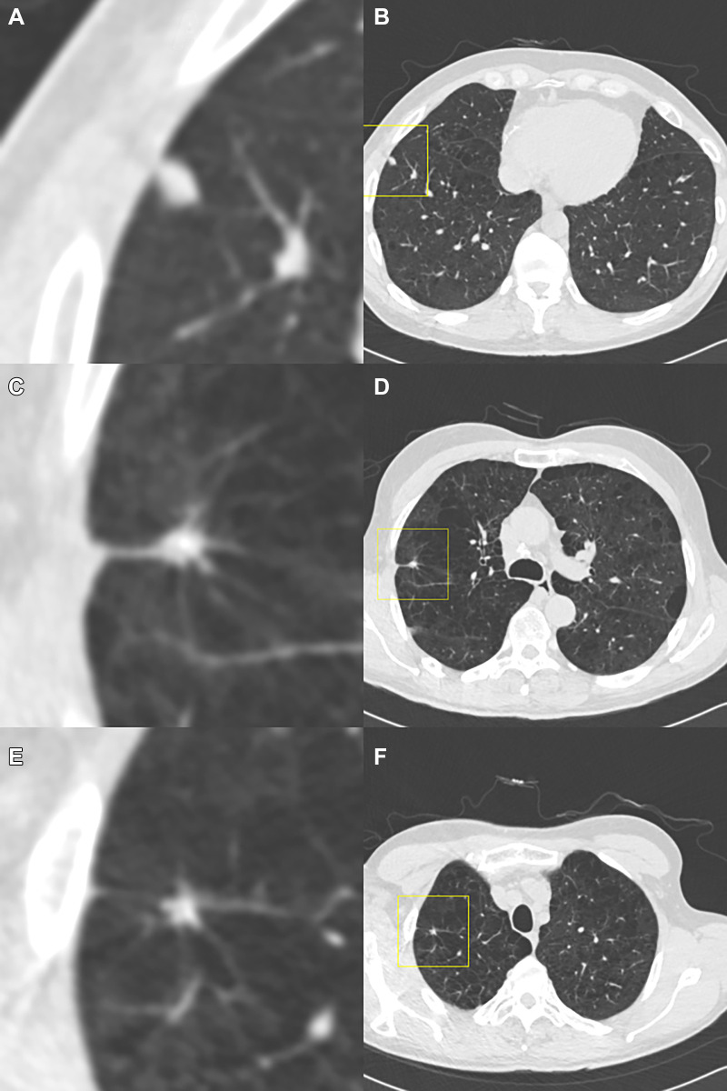 Example of a case in which the observers disagree on the Lung Imaging Reporting and Data System (Lung-RADS) category when reading using the dedicated CT lung screening viewer. This is a case for which the baseline scan was read by all observers. Each image pair (A and B, C and D, and E and F) shows one focal abnormality in a magnified view in the center (axial, field of view of 60 × 60 mm) and in a normal view with a square indicating the location. The three presented focal abnormalities are all detected by the computed-aided detection program. The (A, B) top and (E, F) bottom row show focal abnormalities that were accepted as a nodule by all observers and were measured as being 7 mm and 5 mm in diameter, respectively, by the volumetric software, which would result in a Lung-RADS 3 categorization. (C, D) The middle focal abnormality was only accepted by three of the seven observers as a nodule, was measured as being 8 mm in diameter by the volumetric software, and was determined to not be a nodule (apical fibrosis) by the remaining four observers. As a result, the three observers who accepted the middle focal abnormality as a nodule gave this case a Lung-RADS 4A score, whereas the remaining four observers gave this case a Lung-RADS 3 score.