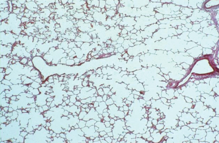 Anatomic basis for understanding pulmonary functional physiologic structure. (a) Magnified view of alveolar ducts and alveoli with orifices in a healthy patient. Alveoli are polygonal in shape and have orifices into alveolar ductal spaces. (b) Histologic sample of the healthy lung with hematoxylin-eosin stain. The divergence from terminal to respiratory bronchioles is shown. (c, d) A radiograph of 1-mm-thick specimen demonstrates the secondary lobules. The pulmonary arteries are located in the center, and pulmonary veins are located in the periphery of the secondary pulmonary lobule. The terminal and respiratory bronchioles are observed as tubular structures accompanying the pulmonary arteries. The primary lobules are indicated as yellow dashed circles in d. (Parts a–d adapted, with permission, from reference 10.) (e) Diagram shows anatomy and dimensions of secondary lobule and pulmonary acinus. Two secondary pulmonary lobules in the lung periphery are illustrated, with approximate dimensions of their components indicated. (Reprinted, with permission, from reference 12.)