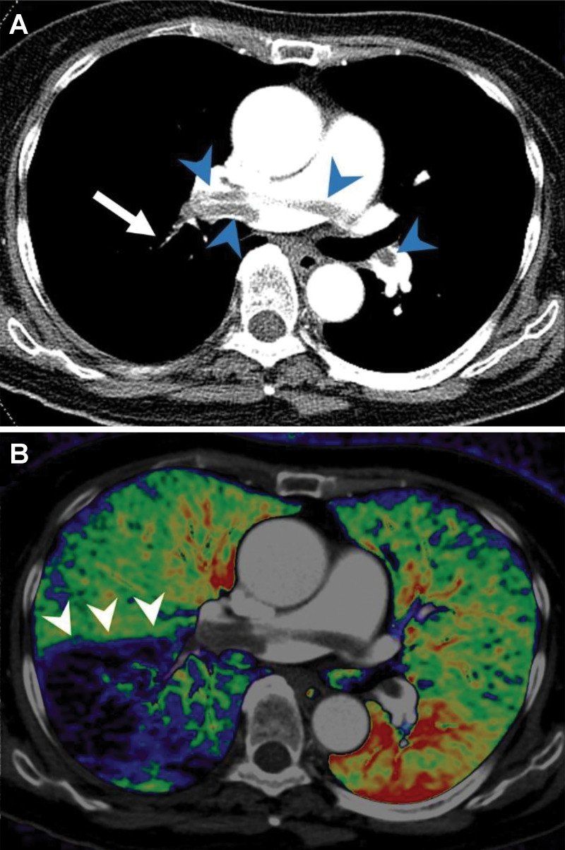 Example of dual-energy CT angiography in a patient with acute pulmonary embolism. A, Axial CT pulmonary arteriographic image shows saddle emboli in the main pulmonary artery and right and left pulmonary arteries (arrowheads) and small clots in a segmental pulmonary artery in the right lower lobe (arrow). B, Axial fusion image of pulmonary blood volume map of dual-energy CT shows large wedge-shaped perfusion defects in the right lower lobe (arrowheads).